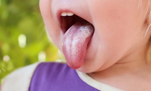 Nepríjemná infekcia v ústnej dutine: Ako sa prejavuje múčnivka?