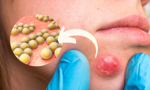 Zlatý stafylokok – príčiny infekcie, príznaky, liečba a prevencia