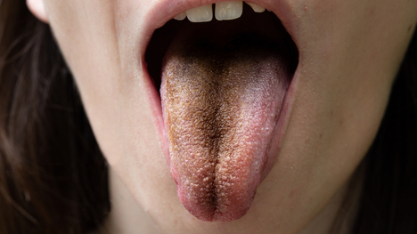 Vyrážky, svrbenie či sfarbenie: Vieš, čo prezrádza jazyk o zdraví?