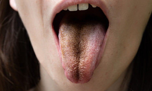 Vyrážky, svrbenie či sfarbenie: Vieš, čo prezrádza jazyk o zdraví?