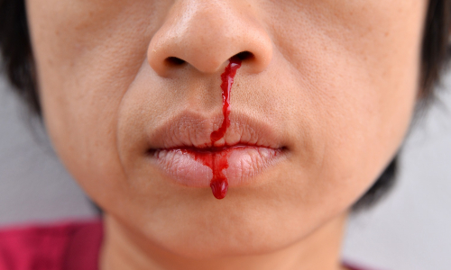 Trápi ťa časté krvácanie z nosa? Pozri, čo všetko môže byť príčinou!
