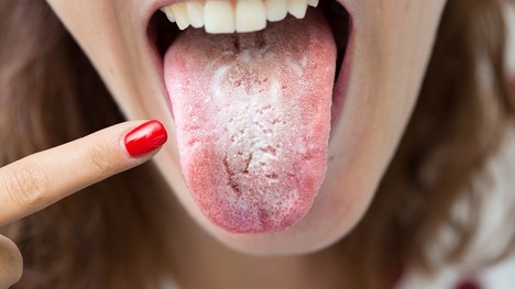 Biely povlak na jazyku – bežný jav alebo vznikajúci problém?