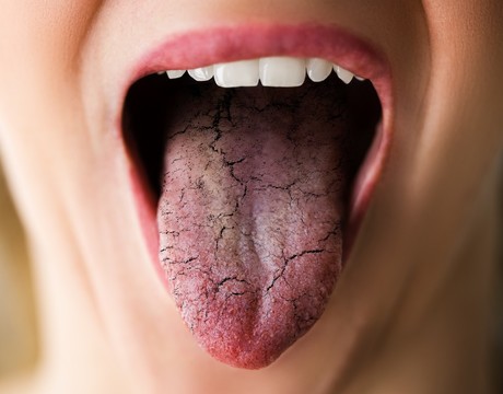 Trápi ťa neustále sucho v ústach? Príčinou nie je iba smäd!