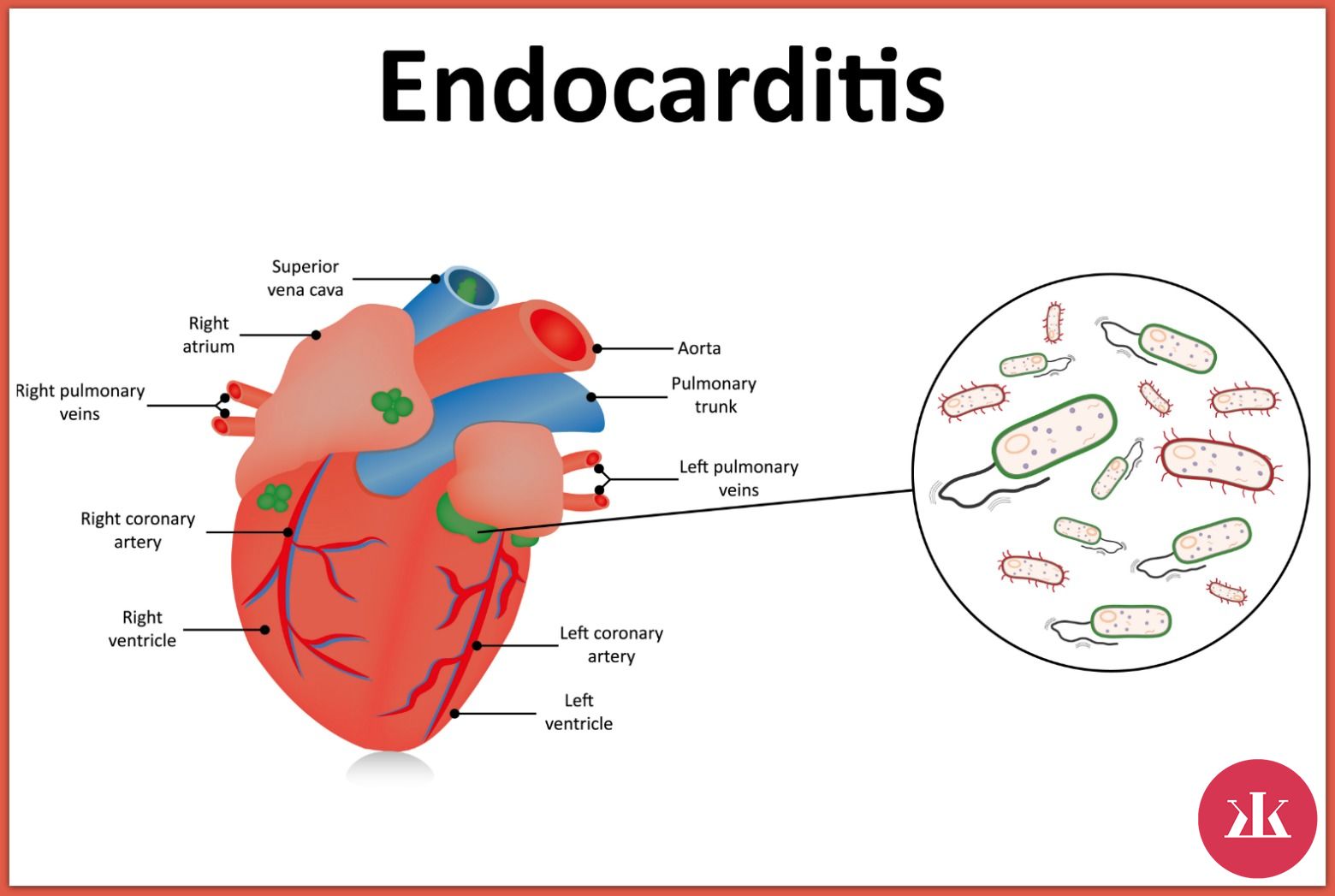 prejavy endokarditídy