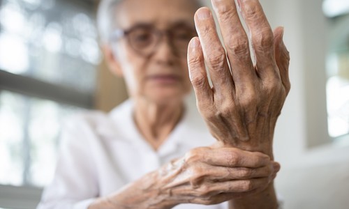 Reumatoidná artritída: V ktorom veku sa začína prejavovať a ako?