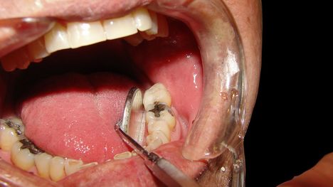 Vysoká výplň v zube - aké problémy vám hrozia?