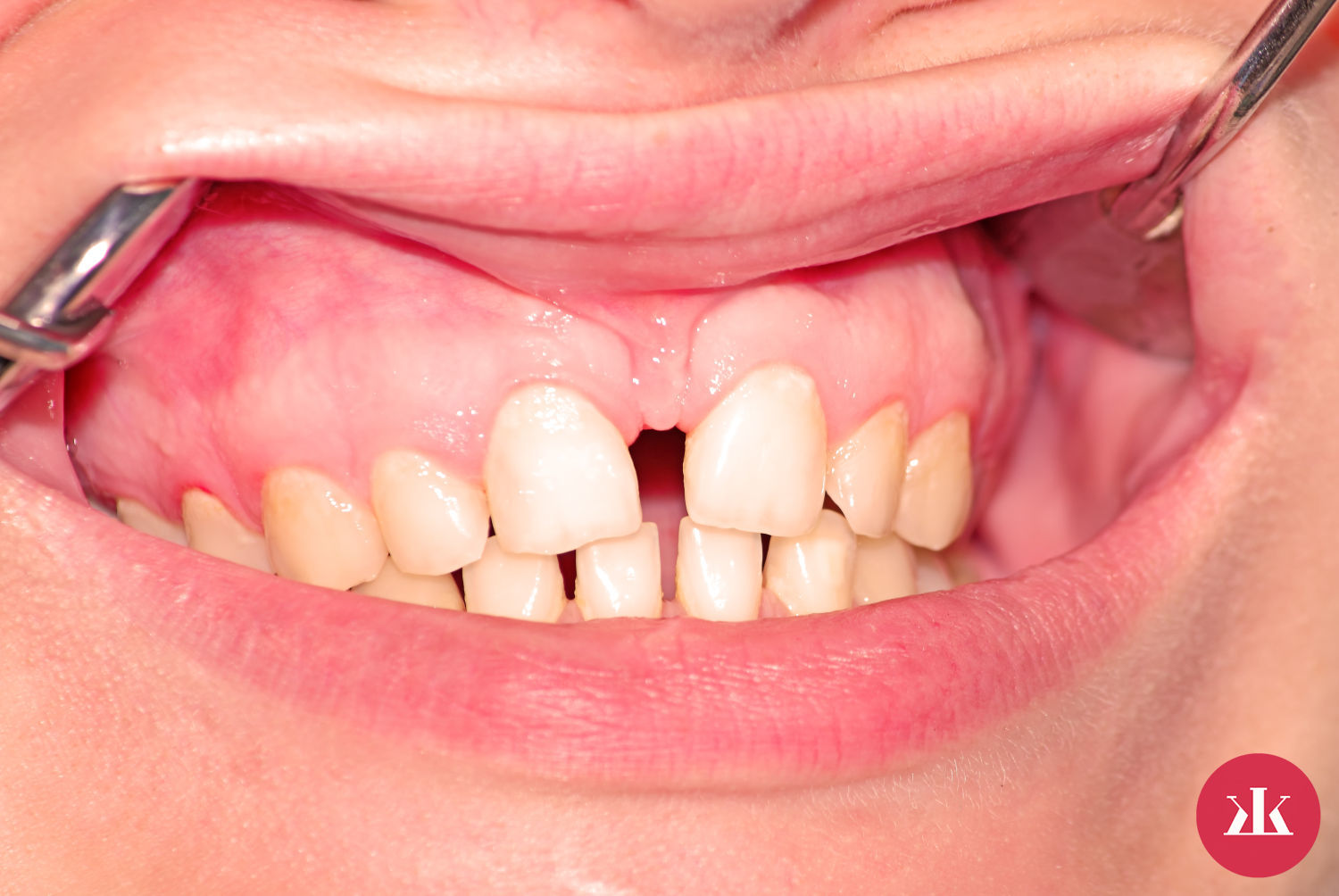 frenulektomia a medzierka medzi zubami