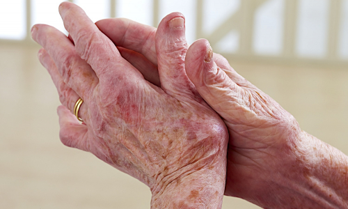 Prevencia artrózy: Nečakaj a urob niečo pre svoje kĺby už dnes!