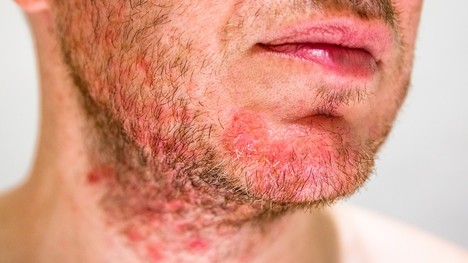 Seboroická dermatitída: Čo môže spustiť rozvoj ochorenia?