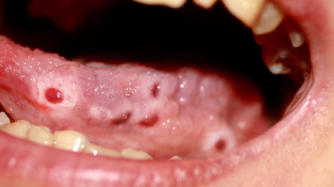 Bolestivé afty v ústach: Triky, ktoré zaberú v priebehu 24 hodín!