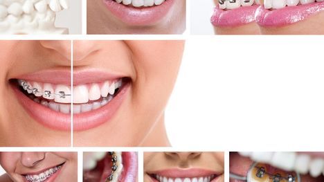Strojček na zuby pre dospelých – aké sú možnosti?