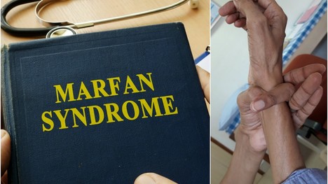 Čo je Marfanov syndróm? Pozor, poukazujú naň tieto príznaky!