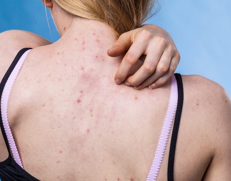 Ako sa zbaviť akné na chrbte? Tieto osvedčené rady ti pomôžu