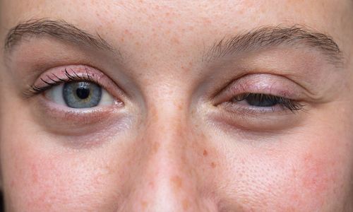 Svalová slabosť a padanie očných viečok: Čo môže byť príčinou?