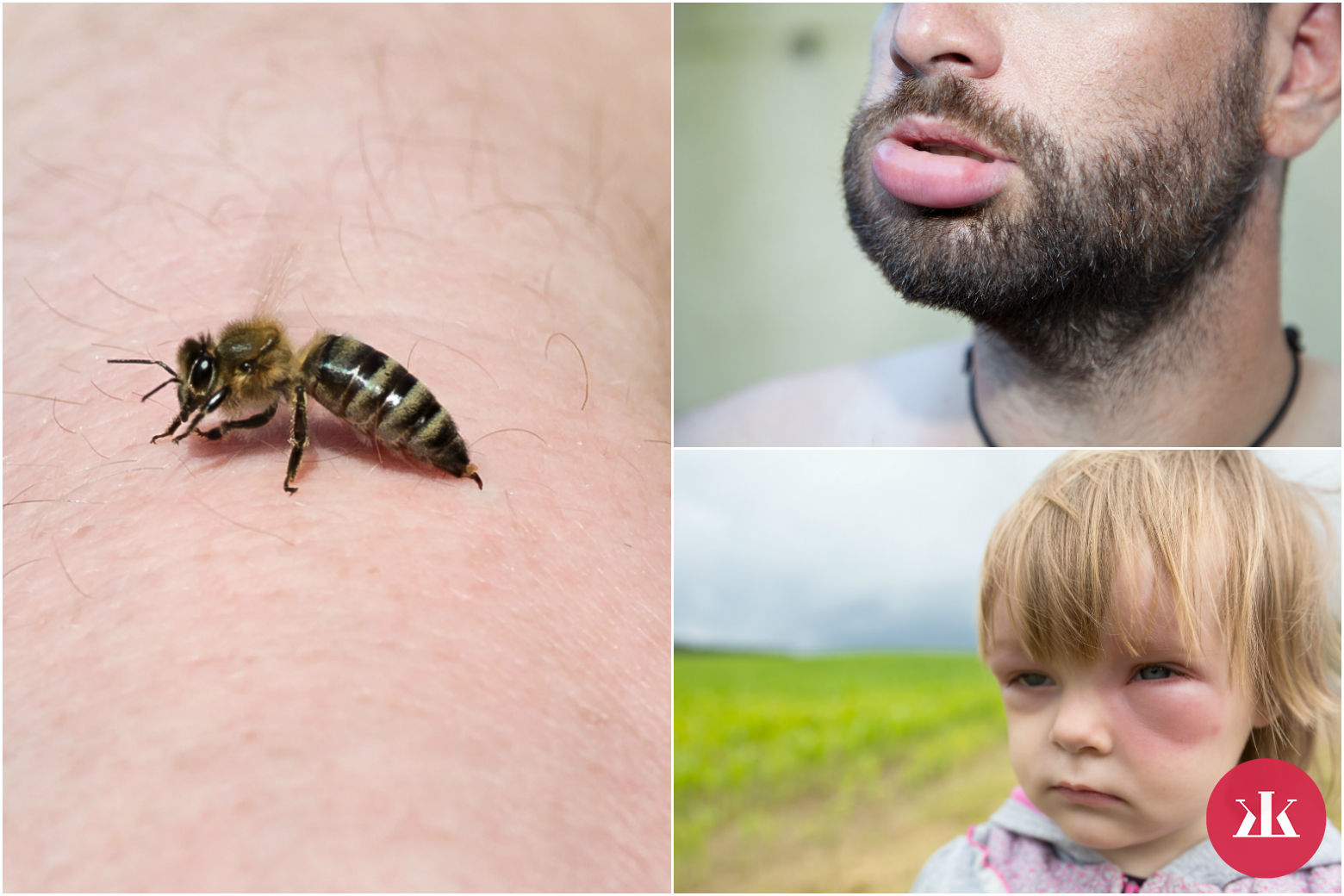 alergická reakcia po bodnutí hmyzom