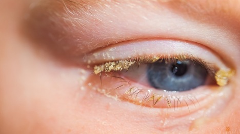 Karpiny v očiach: Neuveríš, čo neočkávané ti môžu prezradiť o zdraví