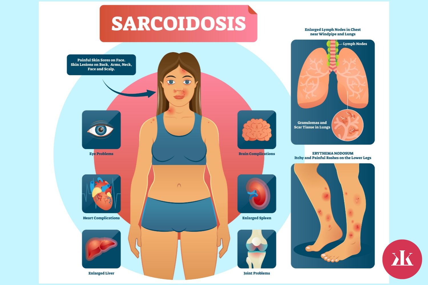 prejavy sarkoidózy