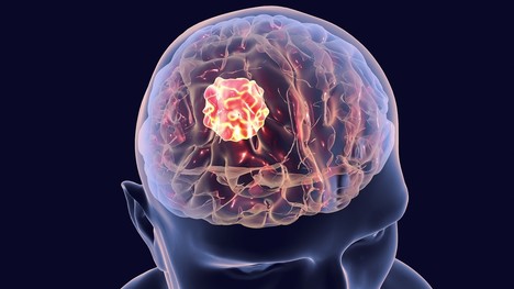 Glióm – nebezpečný nádor na mozgu. Ako sa môže prejavovať?