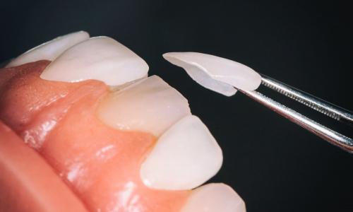 Čo sú zubné fazety a ako dokážu premeniť úsmev na dokonalosť?